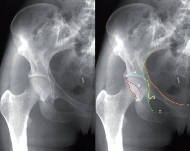 AP pelvis radiograph showing the 6 characteristic radiographic lines for acetabular fracture assessment