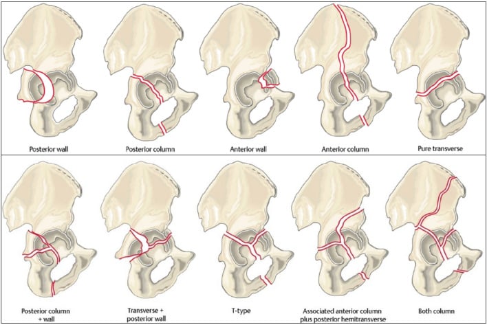 Judet-Letournel classification showing all 10 acetabular fracture patterns