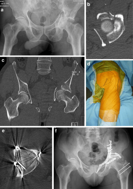 Both-column acetabular fracture case showing preoperative imaging and surgical fixation