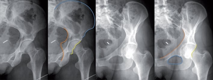 Comparison of iliac oblique and obturator oblique radiographic views with annotated anatomical lines