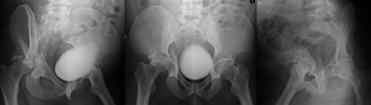 Acetabular fracture case showing obturator oblique, AP pelvis, and iliac oblique radiographic views