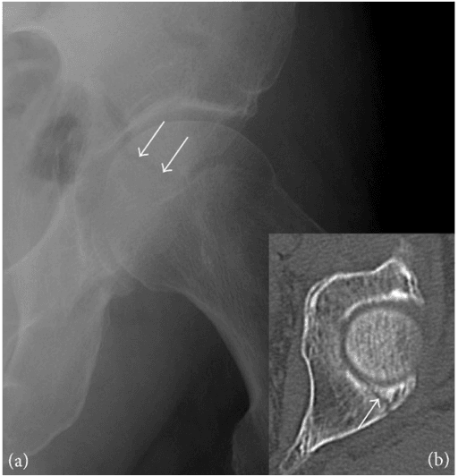 Posterior wall acetabular fracture on radiograph and CT