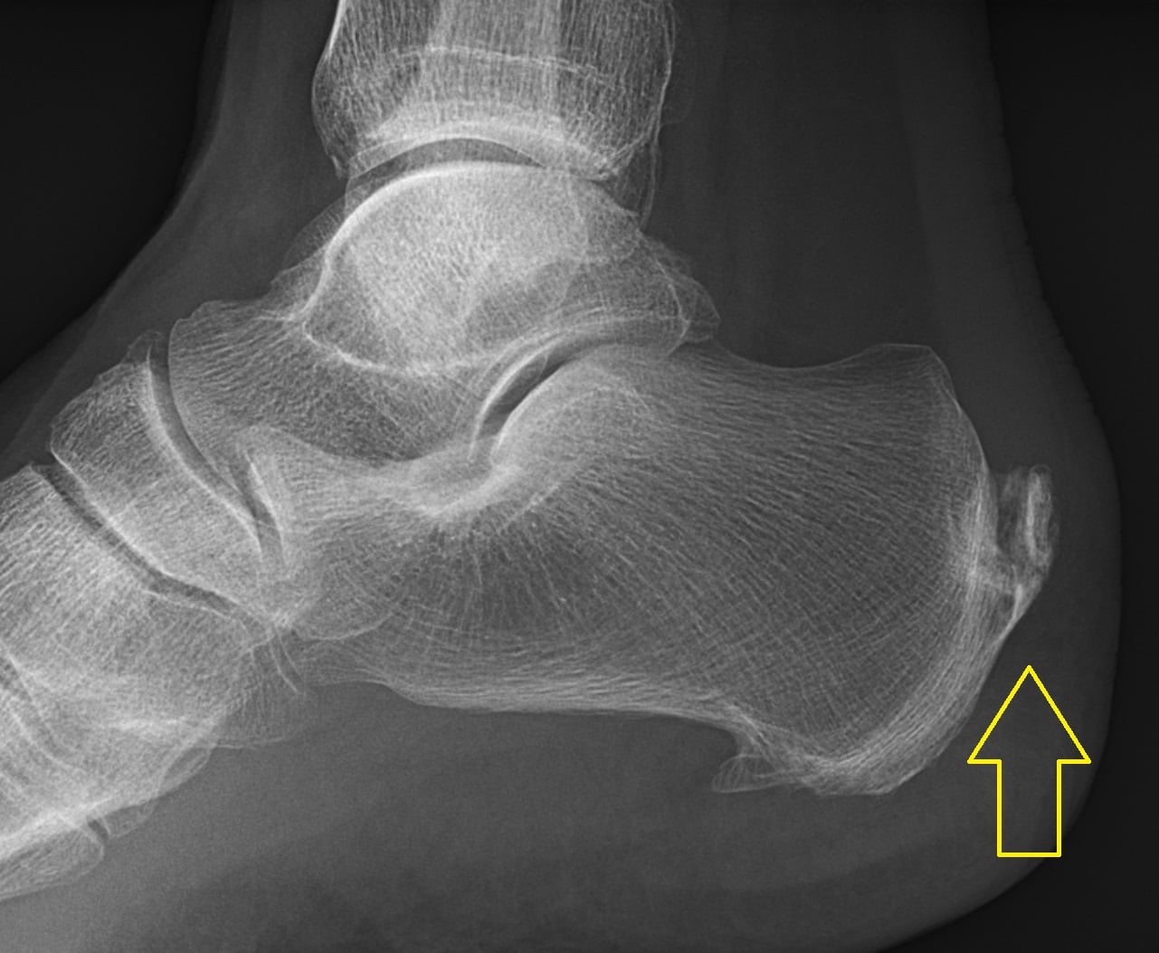 Lateral ankle radiograph with an arrow marking a posterior calcaneal enthesophyte at the Achilles tendon insertion.