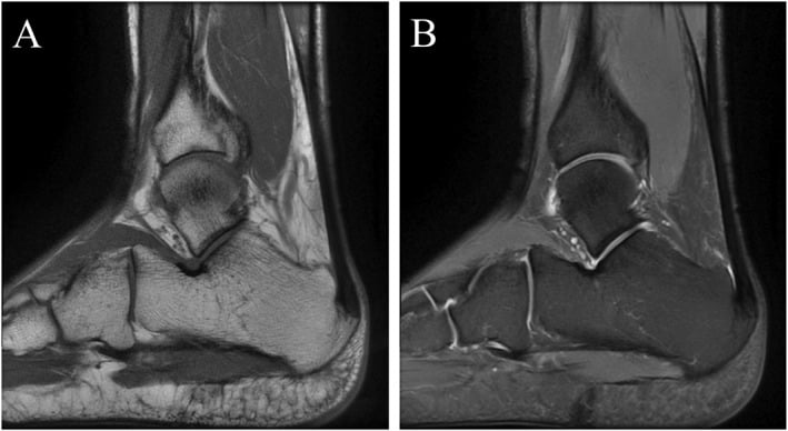 Sagittal MRI showing insertional Achilles tendinopathy and calcaneal spur