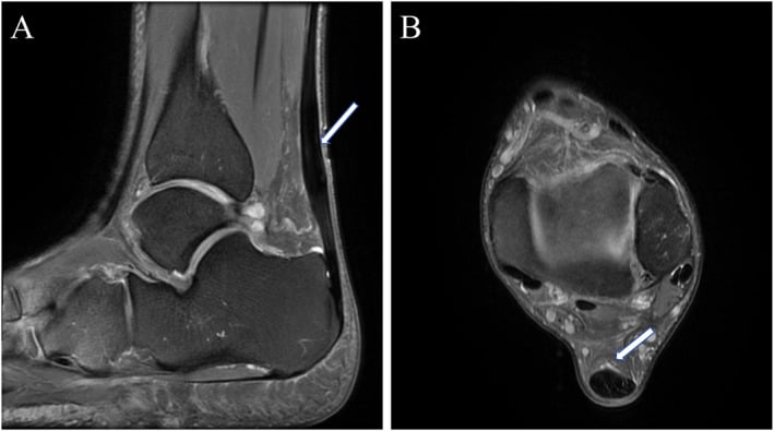 Sagittal and axial MRI showing fusiform mid-portion Achilles tendinopathy