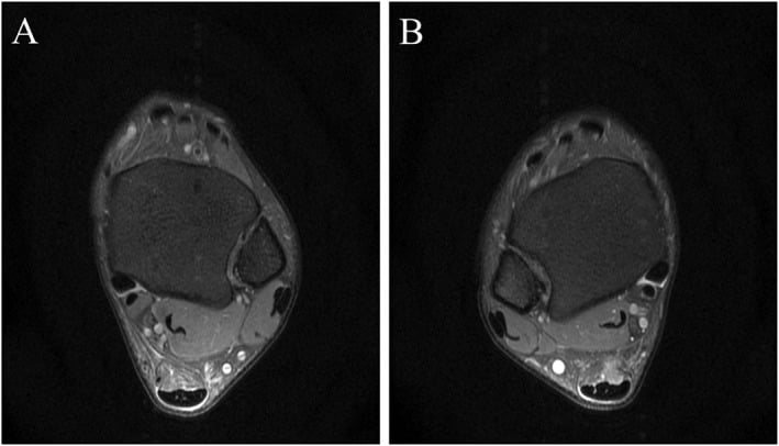 Axial MRI showing circumferential signal around the Achilles tendons in paratendinopathy