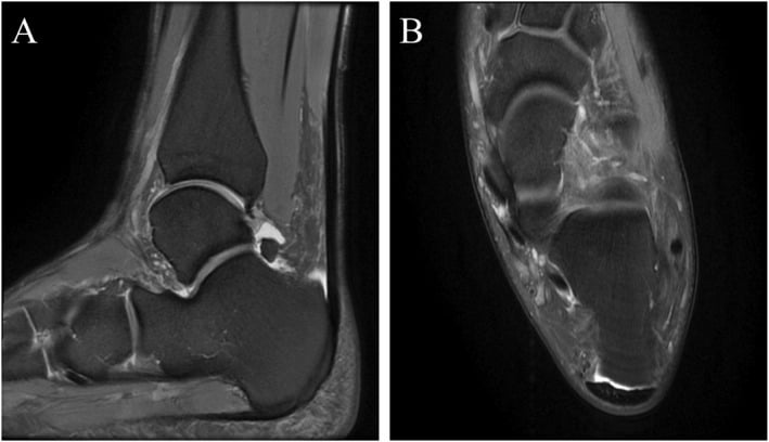 Sagittal and axial MRI showing retrocalcaneal bursal effusion