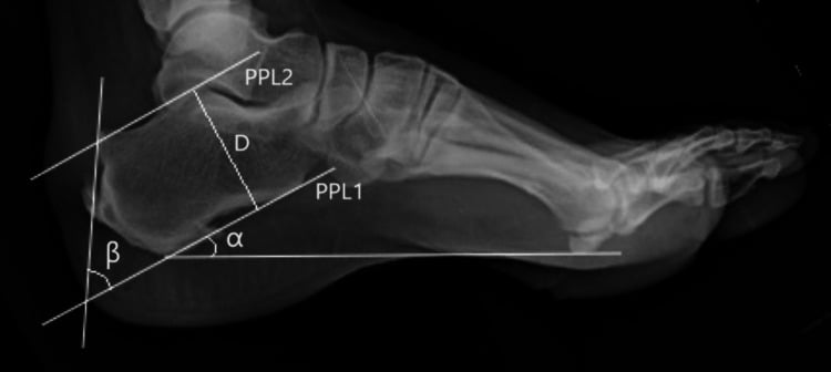 Lateral hindfoot radiograph annotated with parallel pitch lines and calcaneal angles