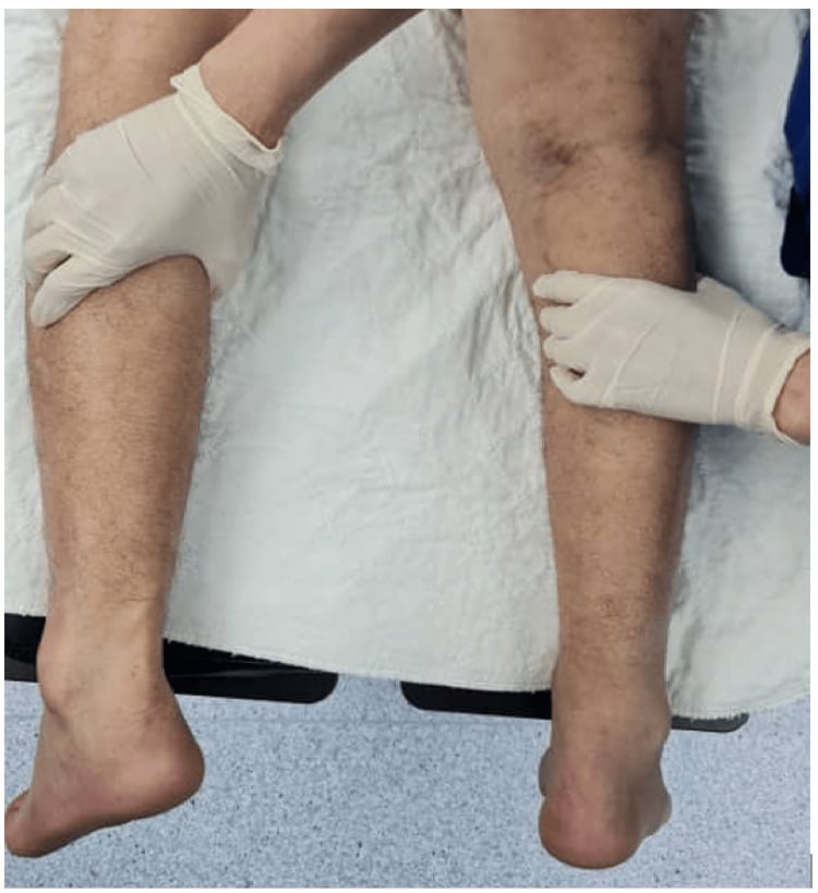 Simmonds-Thompson calf-squeeze test with the foot hanging freely