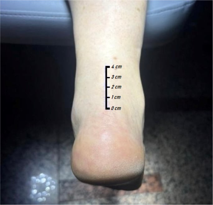 Clinical measurement markings from the Achilles tendon insertion to the mid-portion region