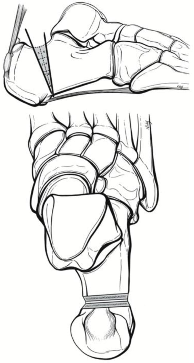 Schematic showing the quadrant cuts for Zadek calcaneal osteotomy