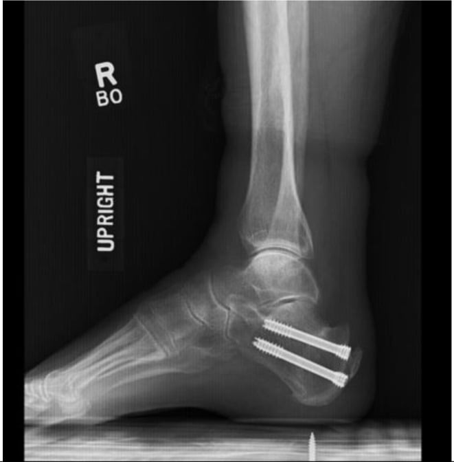 Postoperative lateral ankle radiograph after Zadek calcaneal osteotomy