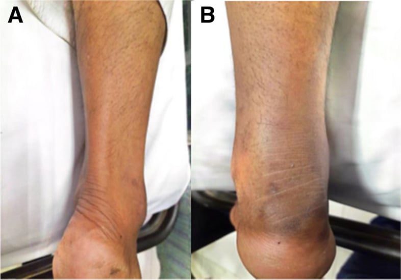 Clinical presentation of acute Achilles tendon rupture showing loss of resting foot posture