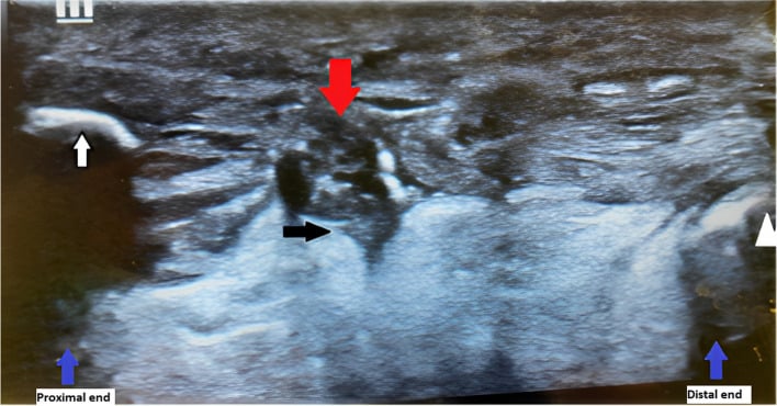 Point-of-care ultrasound showing Achilles tendon rupture with annotations