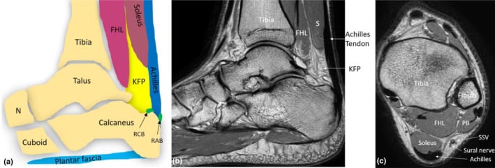 Anatomical schematic and proton-density MRI showing the Achilles tendon, Kager fat pad, flexor hallucis longus and calcaneal bursae in sagittal and axial planes