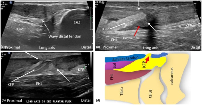 Long-axis ultrasound series showing an acute midsubstance Achilles rupture with non-taut tendon stumps and Kager fat pad herniating into the gap