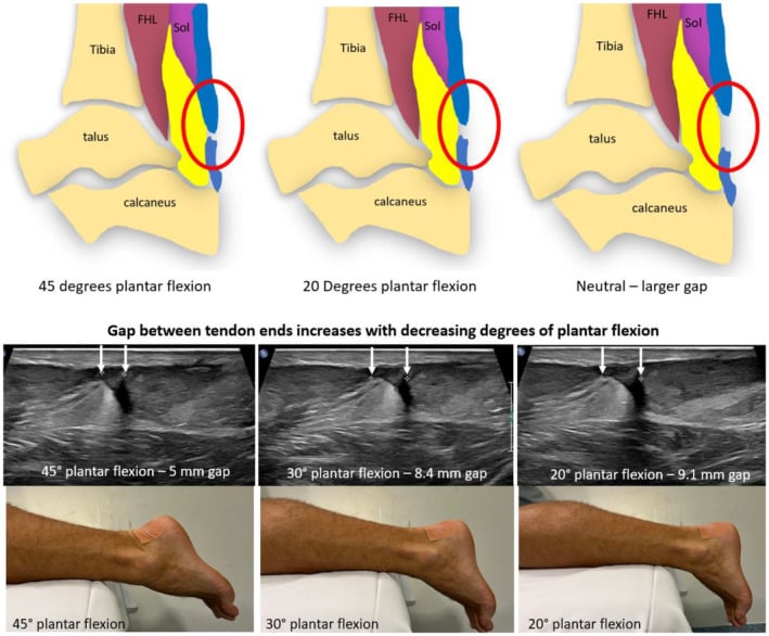 Diagram and serial long-axis ultrasound demonstrating that the gap between ruptured Achilles tendon ends increases as the ankle moves from plantarflexion toward neutral