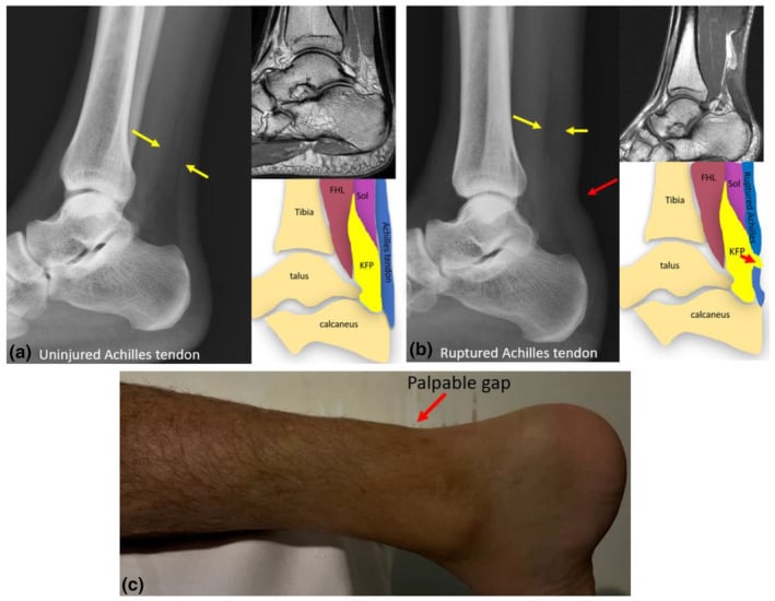 Paired lateral radiographs and sagittal MRI comparing an intact Achilles tendon with a complete rupture and distortion of Kager's triangle
