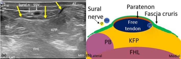 Short-axis ultrasound and anatomical schematic showing the sural nerve and small saphenous vein lateral to the Achilles tendon and superficial to the fascia cruris