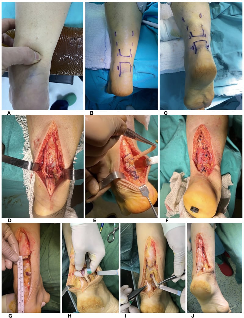 Operative sequence comparing percutaneous Achilles repair, open primary repair and primary repair augmented with flexor hallucis longus