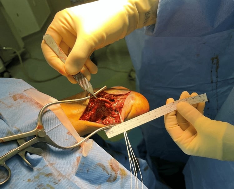 Intraoperative photographs showing the avulsed Achilles tendon end and sutures from calcaneal anchors used for reattachment