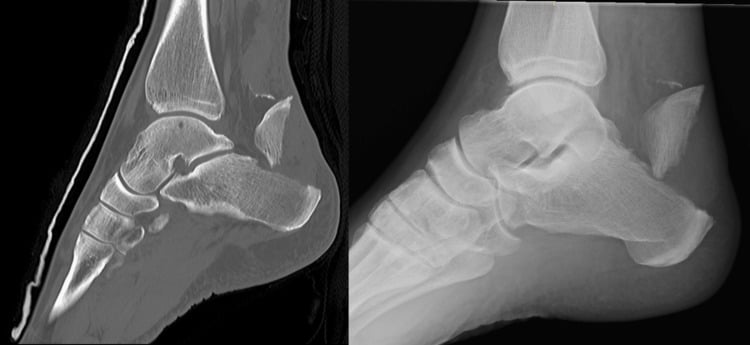 Lateral ankle radiograph and sagittal CT showing a calcaneal tuberosity avulsion fragment associated with complete Achilles tendon rupture