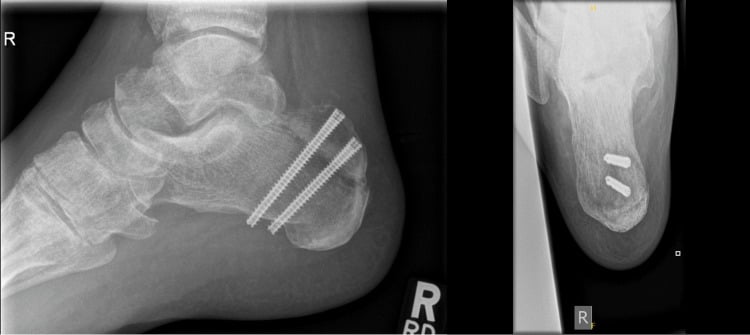 Twelve-week postoperative lateral ankle radiographs showing near-complete union of a fixed calcaneal tuberosity avulsion fracture