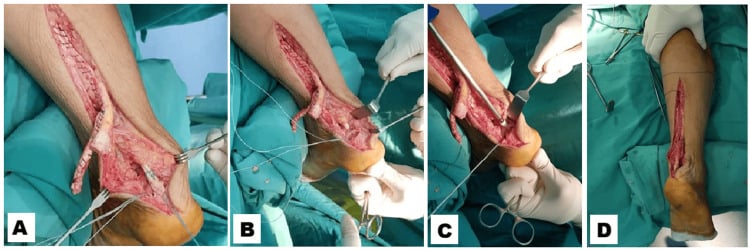 Operative sequence showing flexor hallucis longus identification, harvest proximal to the knot of Henry and interference-screw fixation into the calcaneus