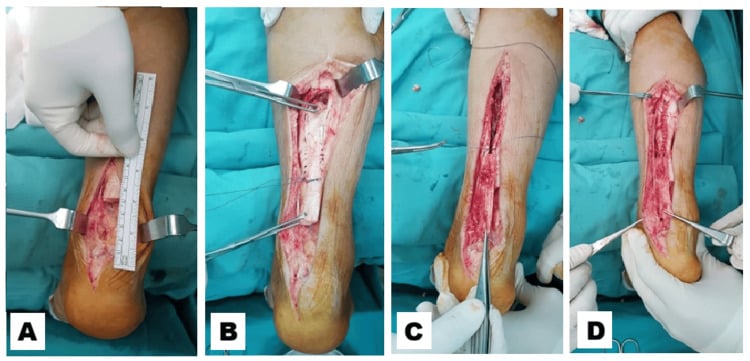 Operative photographs showing debridement and measurement of a chronic Achilles tendon defect followed by creation of a gastrocnemius turndown flap