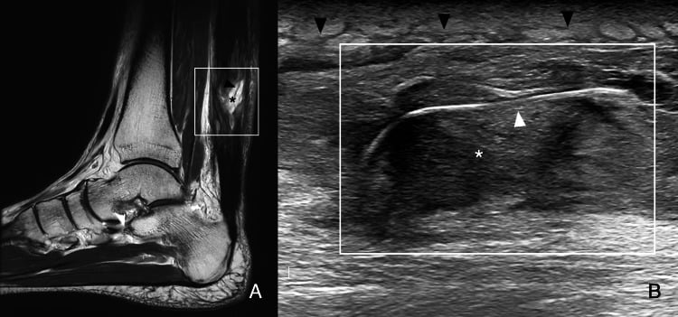 Sagittal MRI and long-axis ultrasound showing a cystic inflammatory lesion and heterogeneous material surrounding non-absorbable sutures after Achilles repair