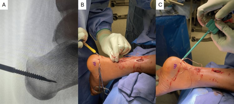 Fluoroscopy and operative photographs showing calcaneal anchor positioning, passage through the distal Achilles stump and final anchor insertion
