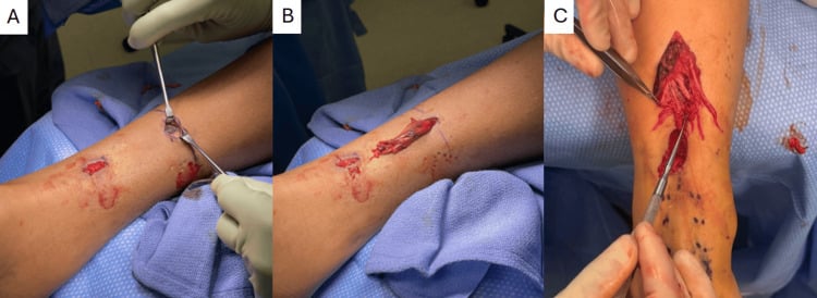 Limited-incision PARS Achilles repair showing the intact paratenon, proximal tendon stump and frayed delaminated tendon fibres