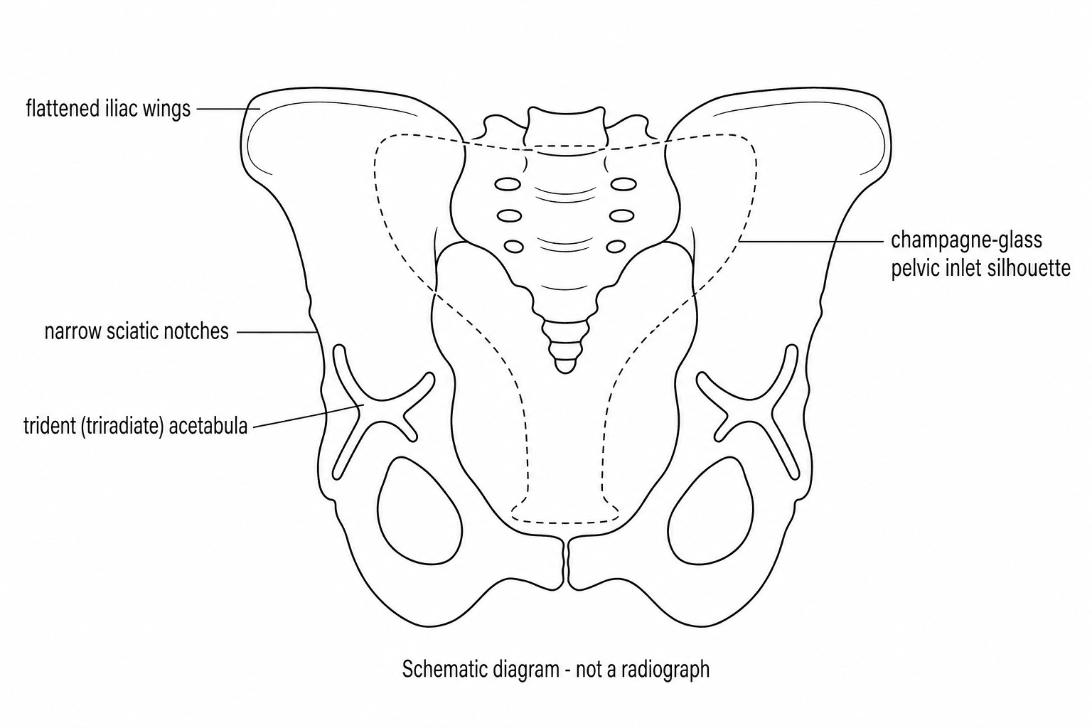 Schematic diagram of the champagne-glass pelvis and trident acetabula pattern in achondroplasia