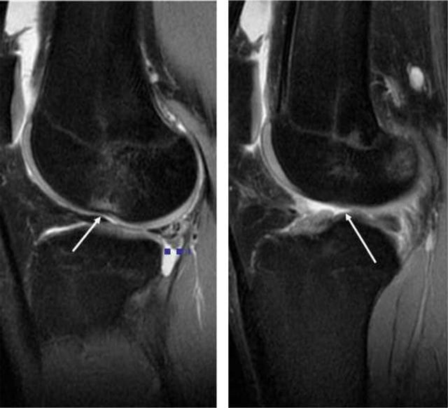 Sagittal knee MRI showing ACL rupture with bone bruise pattern