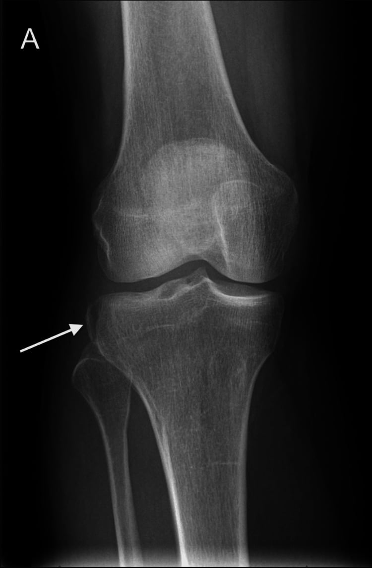 AP knee radiograph showing Segond fracture - pathognomonic for ACL injury