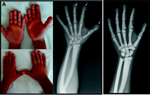 Hand radiograph showing acro-osteolytic distal phalanges alongside a clinical photograph of wrinkled fingertip skin and flattened, grooved nails.