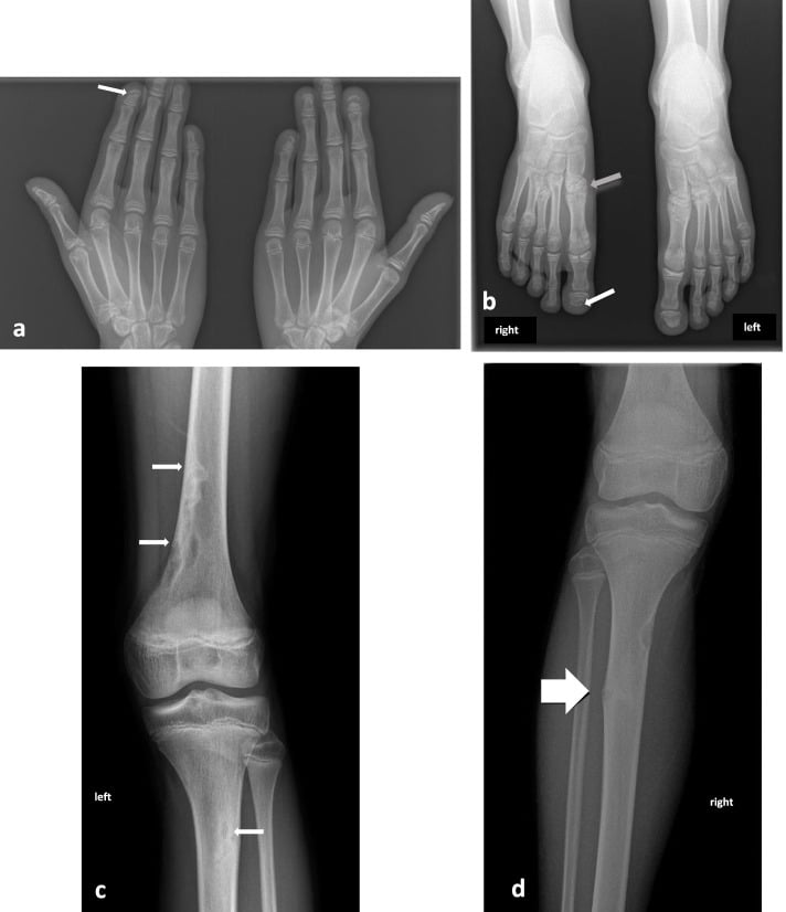 Hand radiograph showing hyperlucent transverse bands through the distal phalanges with preserved distal tufts.
