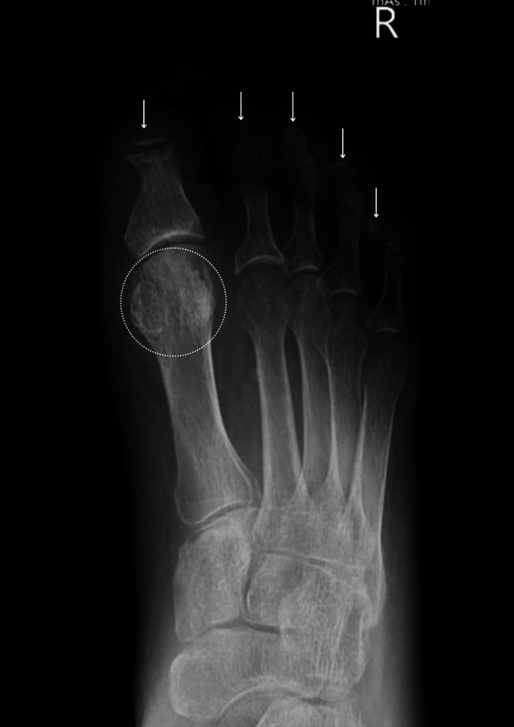 Foot radiograph showing an absent distal phalanx with soft-tissue swelling and permeative change of the proximal phalanx.