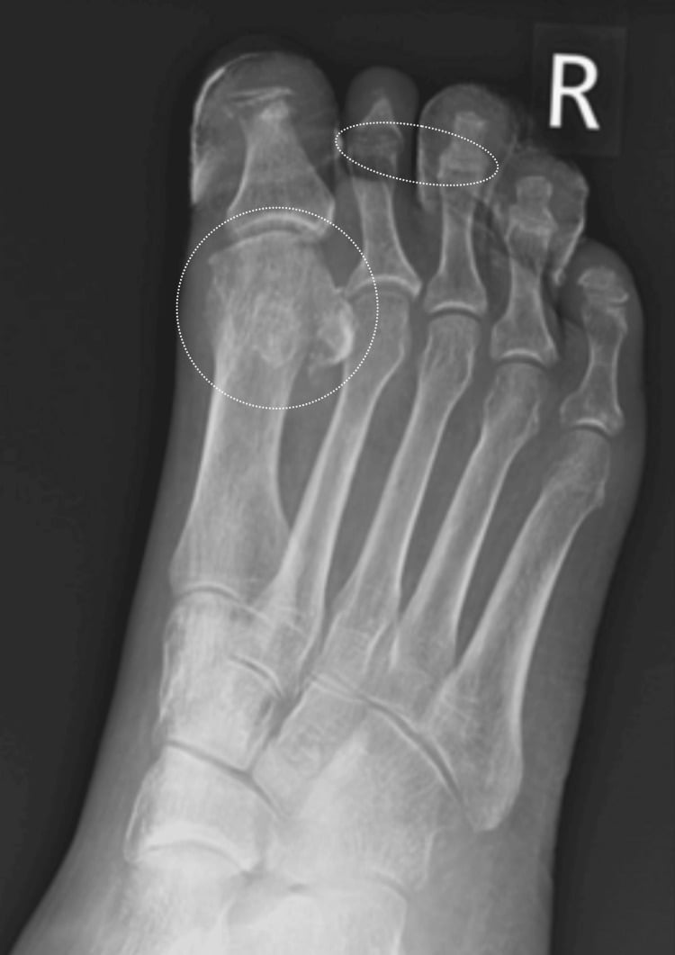 Frontal foot radiograph with annotated resorption of the distal and middle phalanges of the toes.