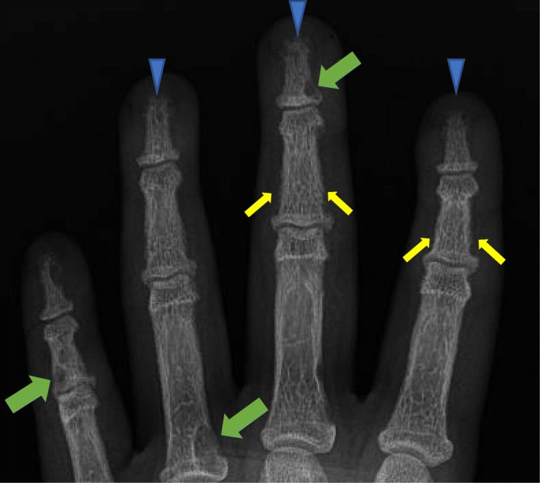 Paediatric hand radiograph with acro-osteolysis and subperiosteal resorption of the radial middle phalanges.