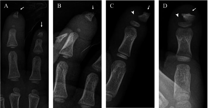 Serial hand radiographs at two and eight years of age showing progressive acro-osteolysis in hereditary sensory neuropathy.
