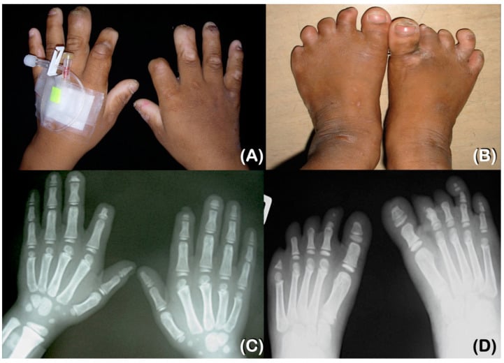 Hand and foot radiographs of a child with congenital insensitivity to pain showing tapered, resorbed phalanges.