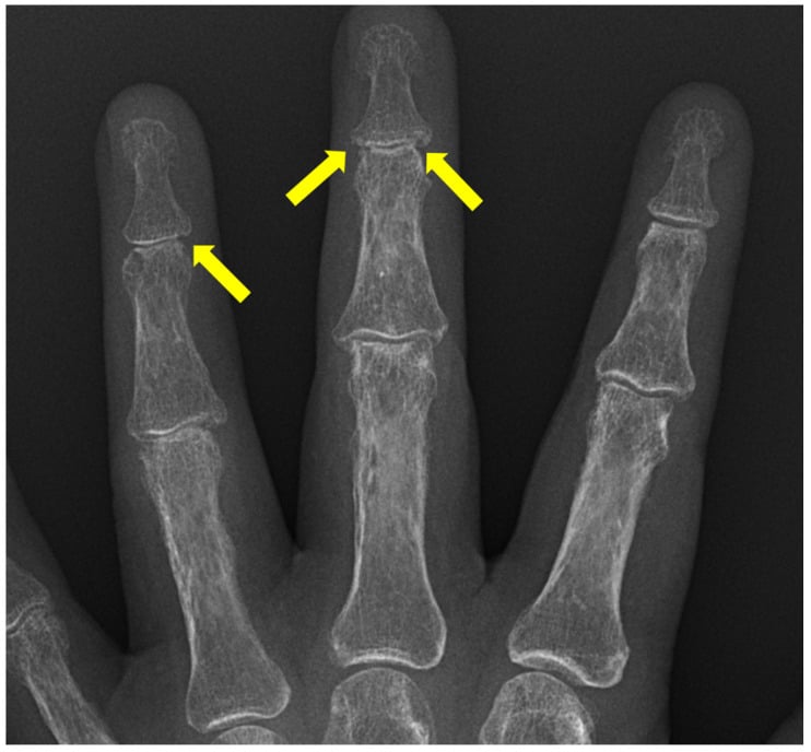 Hand radiograph showing distal interphalangeal erosions with periosteal reaction and acro-osteolysis.