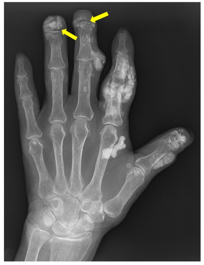 Hand radiograph with partial tuft loss of the middle and ring fingers and soft-tissue calcification.