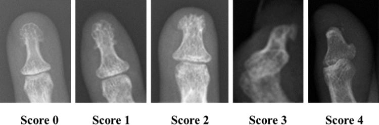 Coned fingertip radiographs illustrating a five-point tuft-resorption score from normal to severe acro-osteolysis.