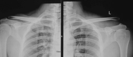 Bilateral shoulder radiograph comparing the normal right acromioclavicular joint with an elevated left distal clavicle and a 10mm scale marker