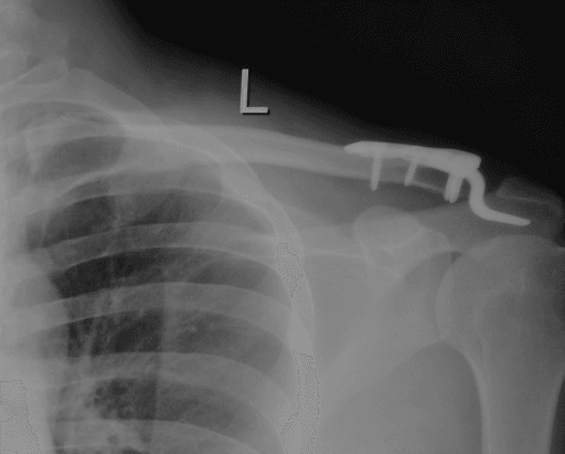 AP left shoulder radiograph showing a clavicular hook plate with the hook passed beneath the acromion holding the joint reduced