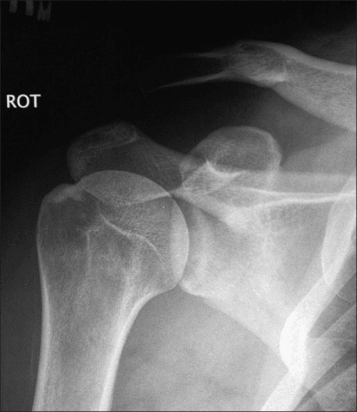 AP shoulder radiograph showing the distal clavicle elevated above the acromion with a widened acromioclavicular joint