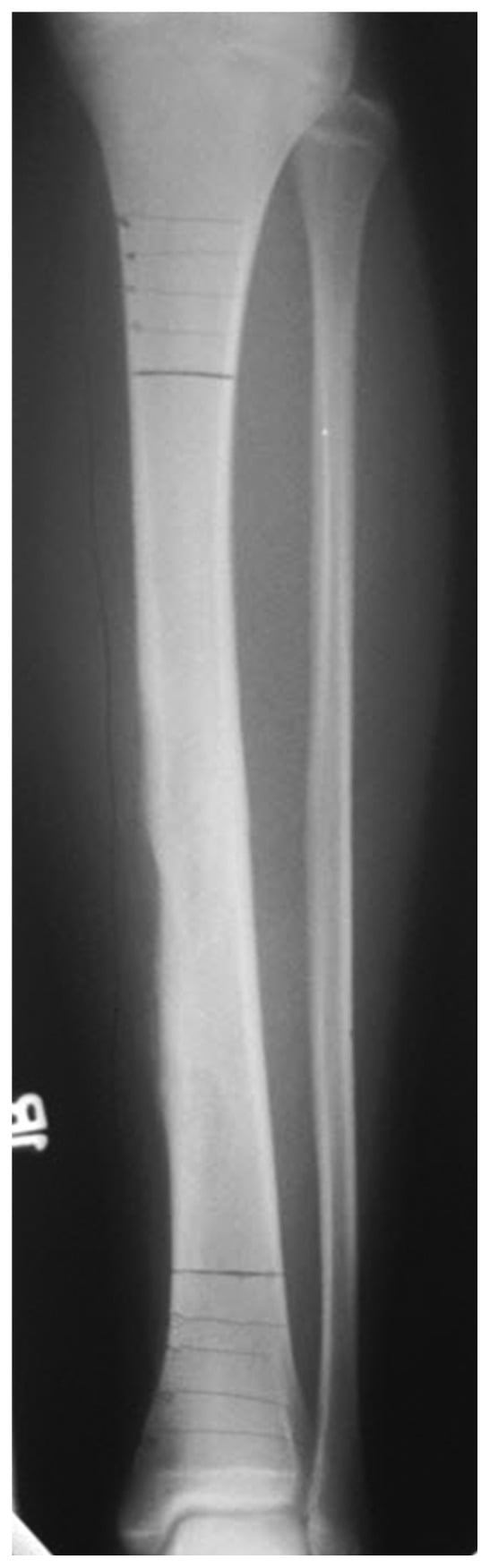 Tibial radiograph showing persistent expansile cortical adamantinoma after curettage and bone grafting