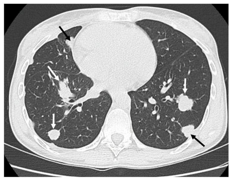 Chest CT showing multiple bilateral cannonball lung metastases from adamantinoma